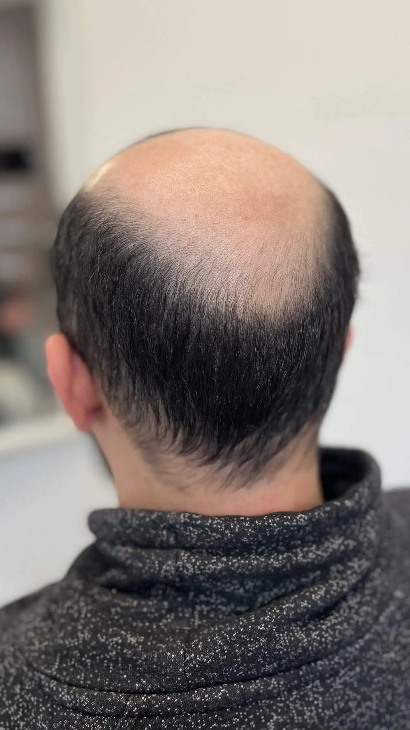 A Men With A Bald Head.