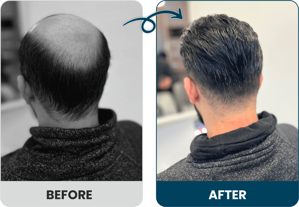 Men's Hair Systems Before & After Look