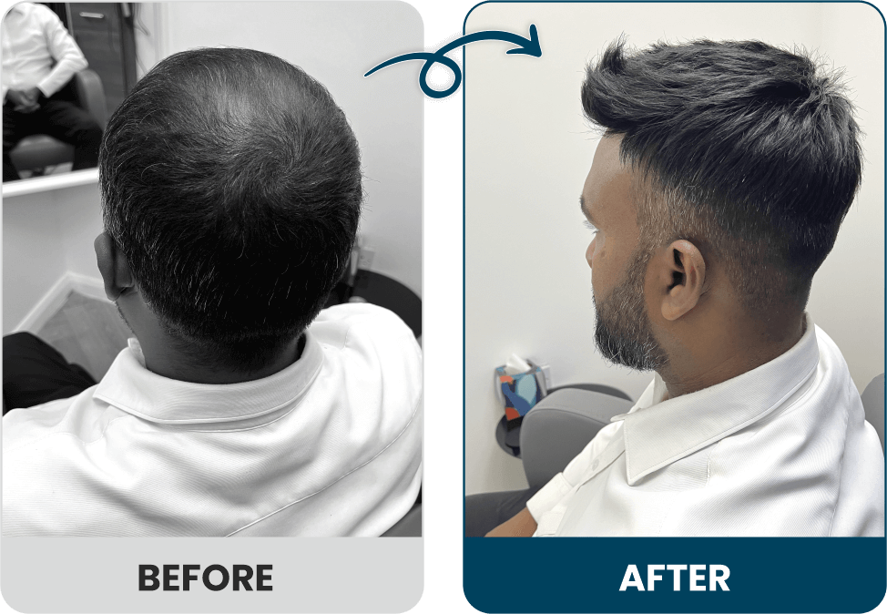 Men's Hair Systems Before & After Look