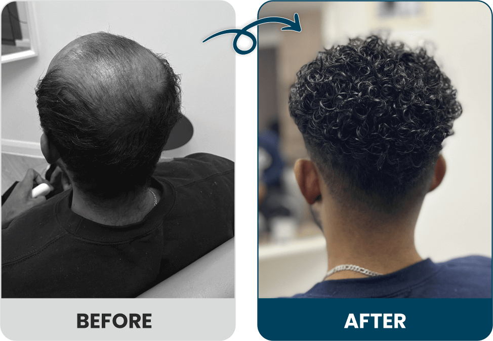 Men's Hair Systems Before & After Look