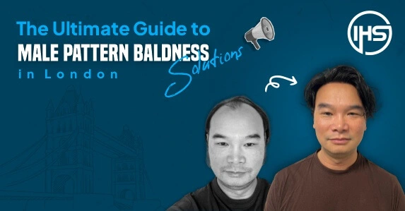 The Ultimate Guide to Male Pattern Baldness Solutions in London